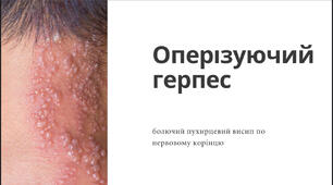 Оперізуючий герпес