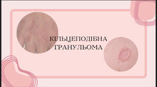 Кільцеподібна гранульома