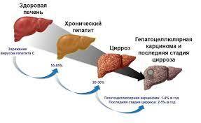 K73 Хронический гепатит | Описание болезни, диагностика, лечение