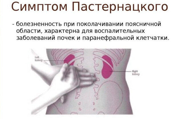Пальпація та перкусія нирок: як проводиться, методи